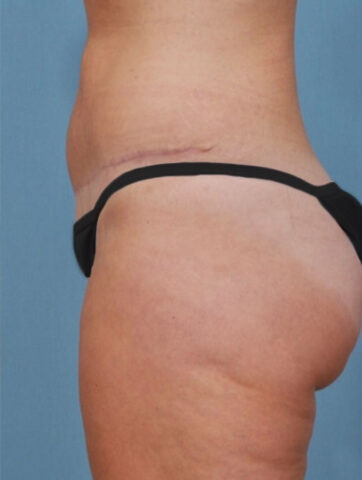 Case # 2 after photo