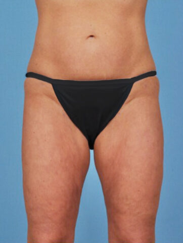 Case # 3 after photo