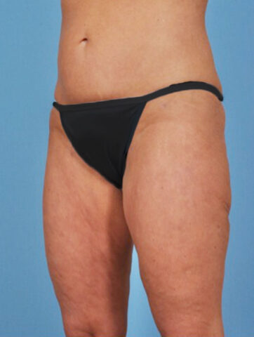 Case # 3 after photo