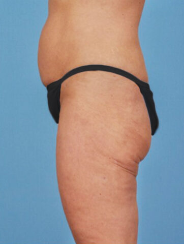 Case # 3 after photo