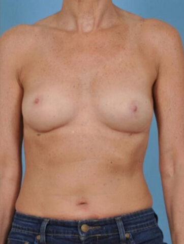 Case # 2 after photo