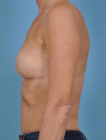 Case # 2 after photo