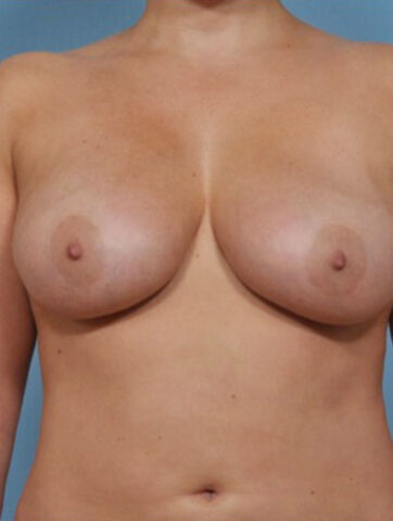 Case # 6 after photo