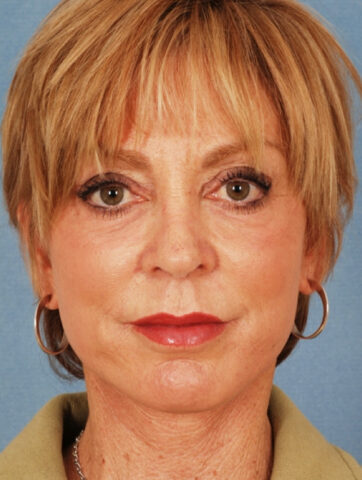 Case # 2 after photo