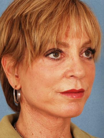 Case # 2 after photo