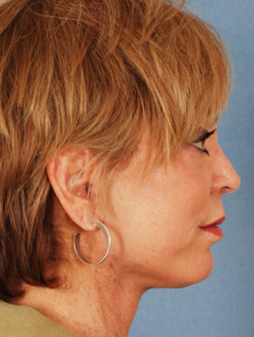 Case # 2 after photo