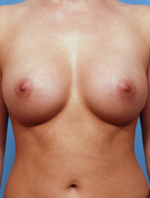 before and after gallery image