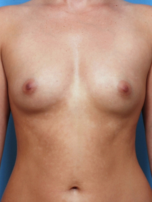 before and after gallery image
