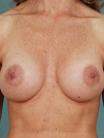 Case # 4 after photo