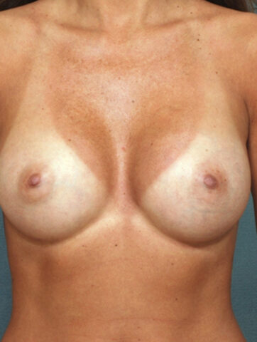 Case # 2 after photo