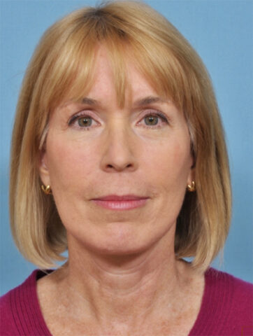 Case # 4 after photo