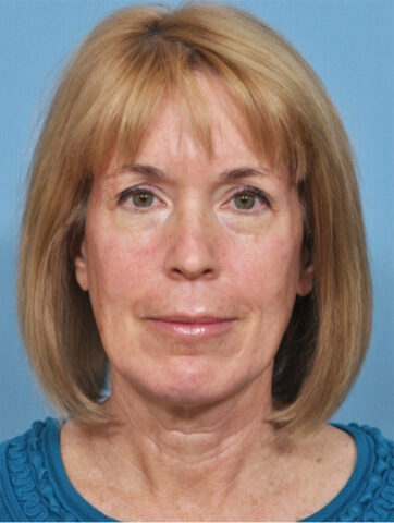 Case # 4 before photo