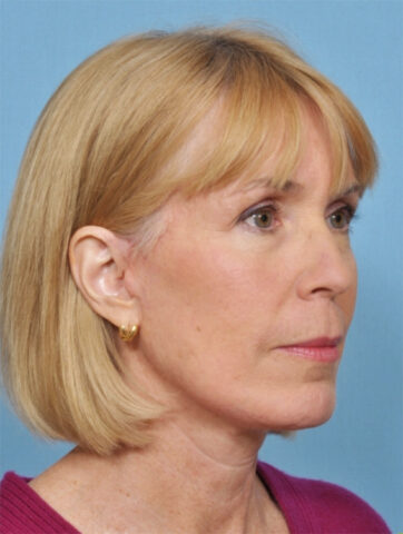 Case # 4 after photo