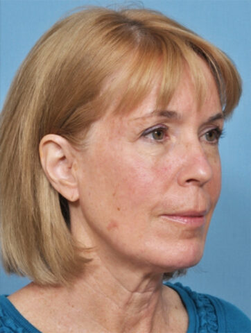 Case # 4 before photo