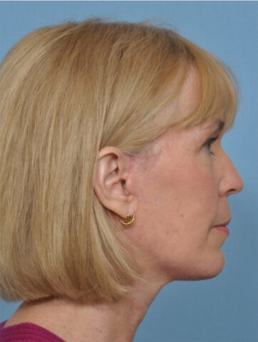 Case # 4 after photo