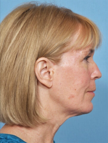 Case # 4 before photo