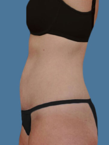 Case # 4 after photo