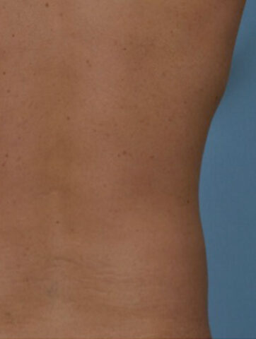 Case # 6 after photo