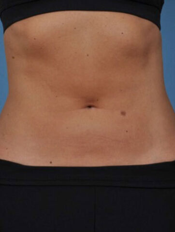 Case # 3 after photo