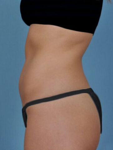 Case # 1 after photo