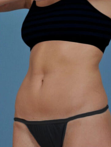 Case # 1 after photo