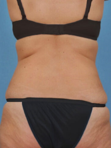 Case # 2 after photo