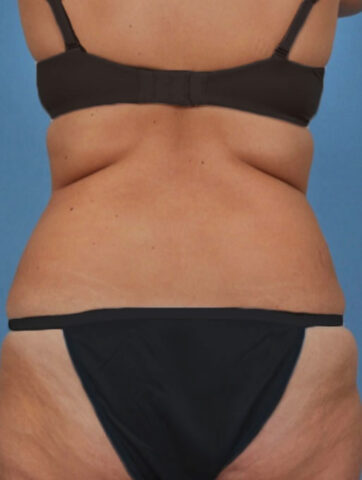 Case # 2 before photo