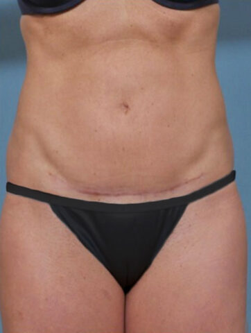 Case # 1 after photo