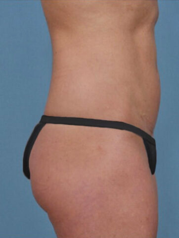 Case # 1 after photo