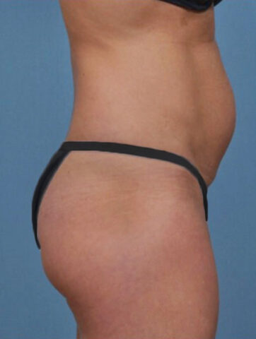 Case # 1 before photo