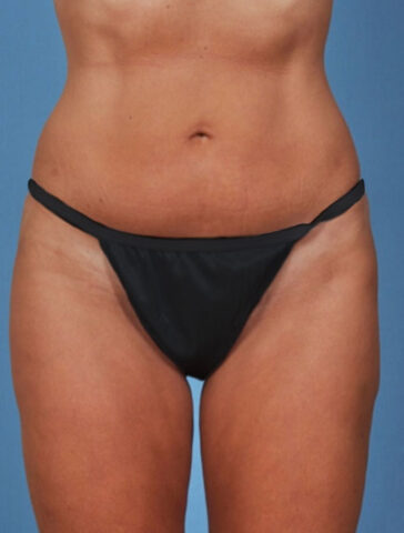 Case # 1 after photo