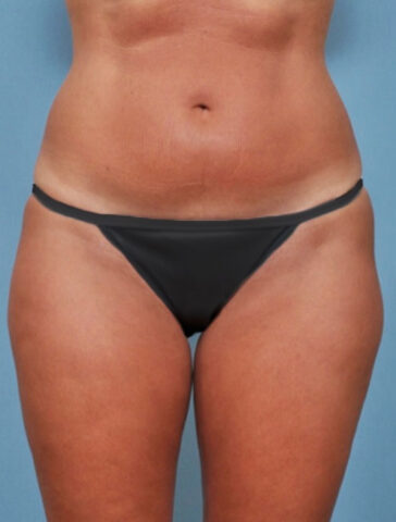 Case # 1 before photo