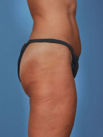 Case # 1 after photo