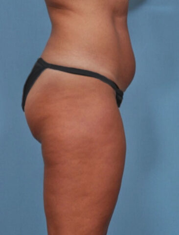 Case # 1 before photo