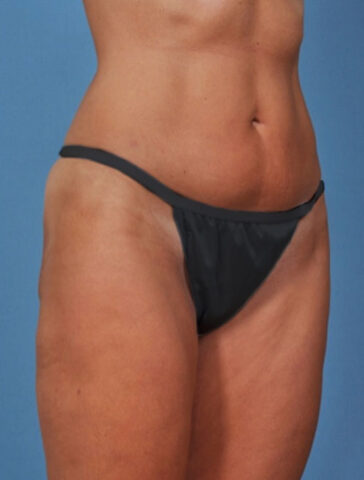 Case # 1 after photo