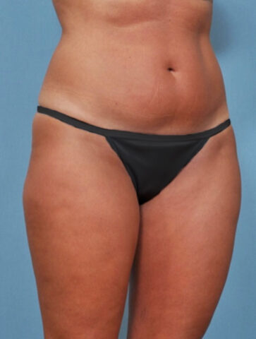 Case # 1 before photo