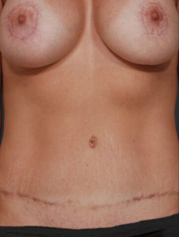 Case # 3 after photo