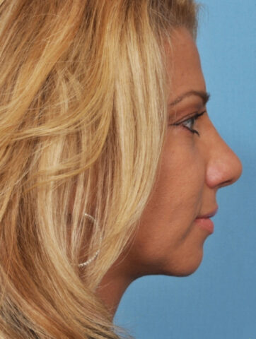 Case # 6 after photo