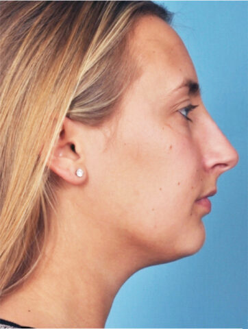 Case # 3 after photo