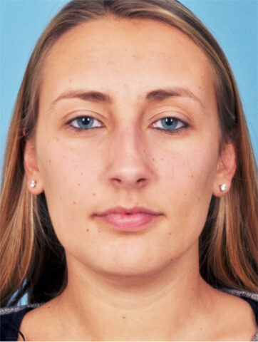 Case # 3 after photo