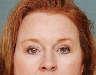 Case # 5 after photo