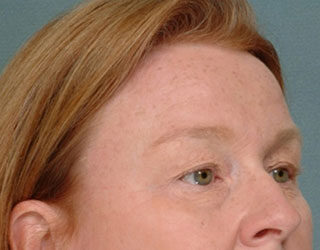 Case # 5 before photo