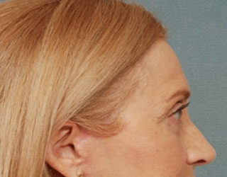 Case # 4 after photo