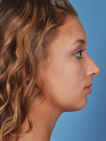 Case # 4 after photo