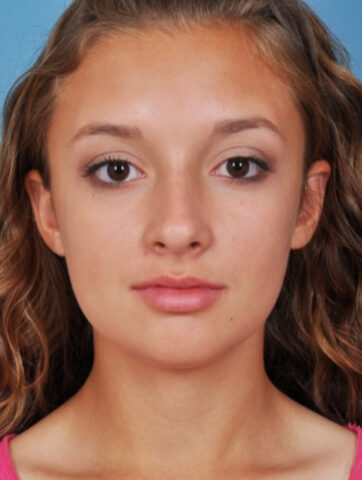 Case # 4 after photo