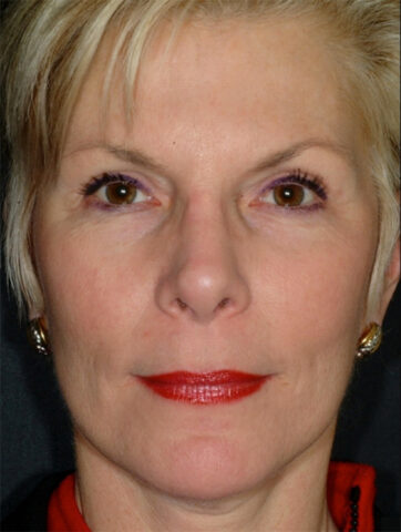 Case # 3 after photo