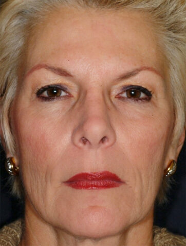 Case # 3 before photo