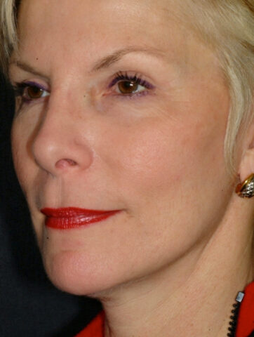 Case # 3 after photo