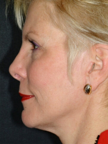 Case # 3 after photo