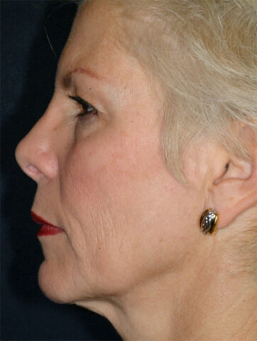 Case # 3 before photo